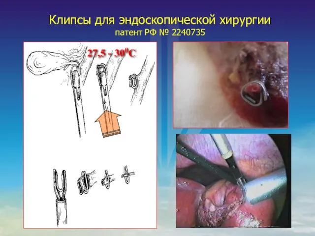 Клипсы для эндоскопической хирургии патент РФ № 2240735 27,5 - 300С