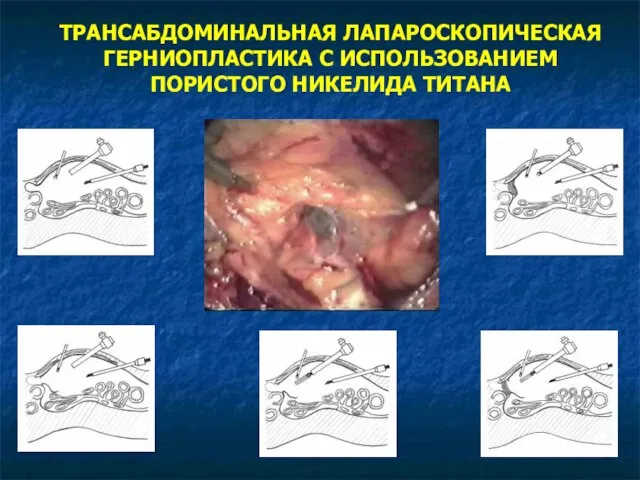 ТРАНСАБДОМИНАЛЬНАЯ ЛАПАРОСКОПИЧЕСКАЯ ГЕРНИОПЛАСТИКА С ИСПОЛЬЗОВАНИЕМ ПОРИСТОГО НИКЕЛИДА ТИТАНА