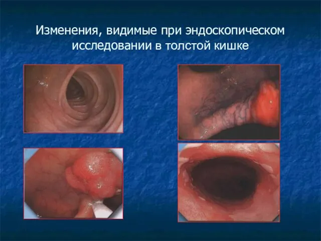 Изменения, видимые при эндоскопическом исследовании в толстой кишке