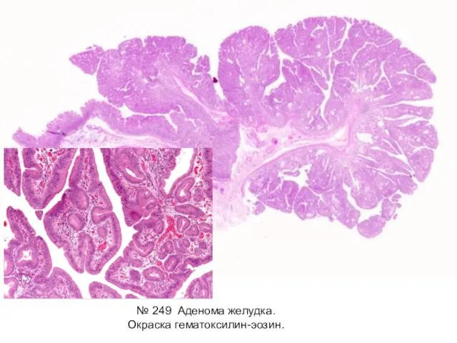 № 249 Аденома желудка. Окраска гематоксилин-эозин.