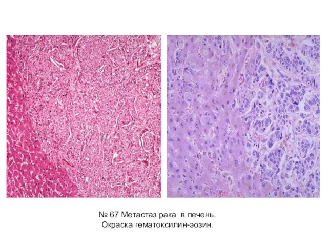 № 67 Метастаз рака в печень. Окраска гематоксилин-эозин.