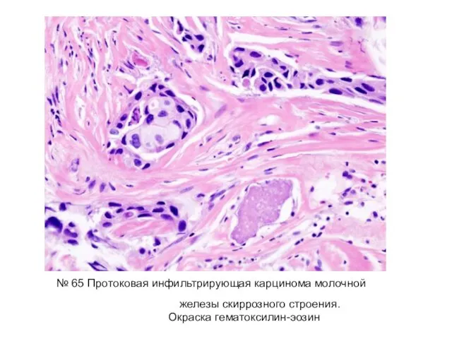 № 65 Протоковая инфильтрирующая карцинома молочной железы скиррозного строения. Окраска гематоксилин-эозин