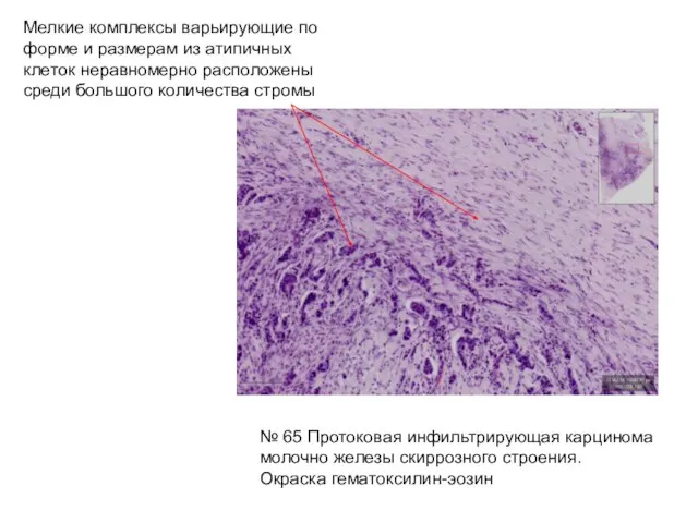 № 65 Протоковая инфильтрирующая карцинома молочно железы скиррозного строения. Окраска гематоксилин-эозин