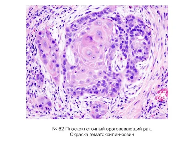 № 62 Плоскоклеточный ороговевающий рак. Окраска гематоксилин-эозин