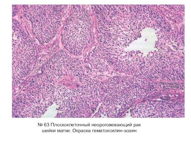№ 63 Плоскоклеточный неороговевающий рак шейки матки. Окраска гематоксилин-эозин