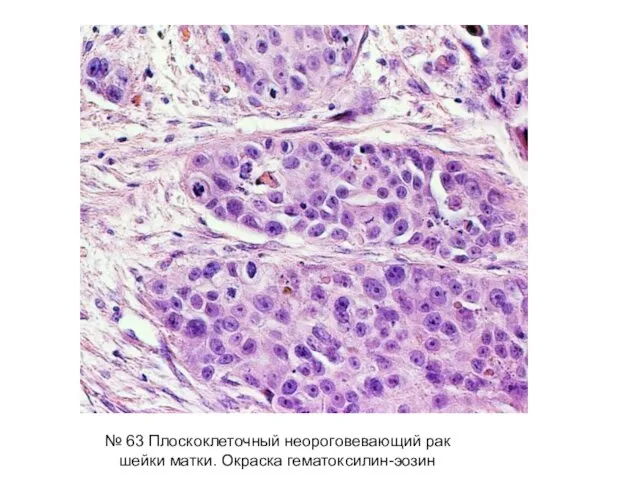 № 63 Плоскоклеточный неороговевающий рак шейки матки. Окраска гематоксилин-эозин