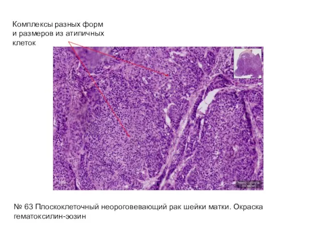 Комплексы разных форм и размеров из атипичных клеток № 63 Плоскоклеточный