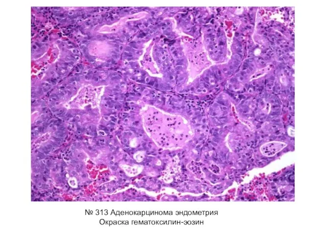№ 313 Аденокарцинома эндометрия Окраска гематоксилин-эозин