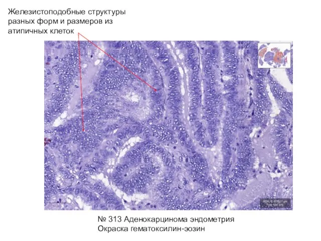 Железистоподобные структуры разных форм и размеров из атипичных клеток № 313 Аденокарцинома эндометрия Окраска гематоксилин-эозин