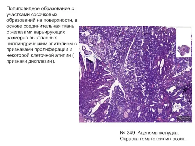 № 249 Аденома желудка. Окраска гематоксилин-эозин. Полиповидное образование с участками сосочковых
