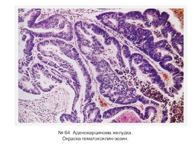 № 64 Аденокарцинома желудка. Окраска гематоксилин-эозин.
