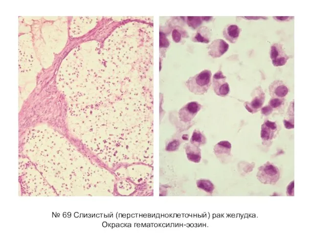 № 69 Слизистый (перстневидноклеточный) рак желудка. Окраска гематоксилин-эозин.