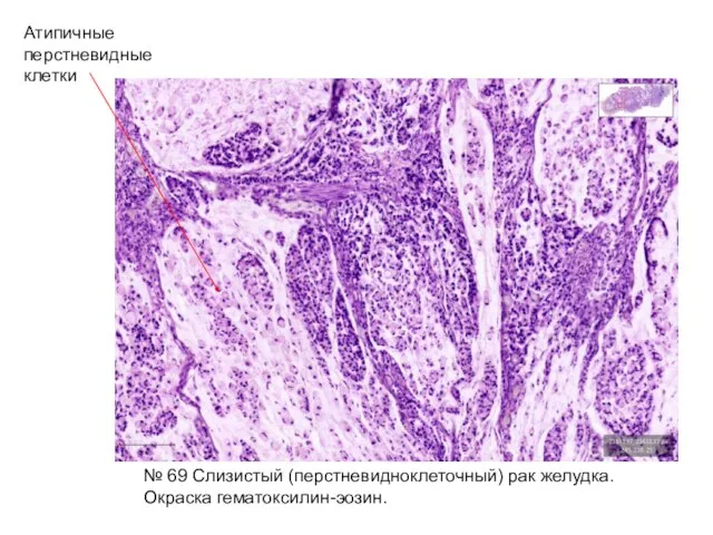 Атипичные перстневидные клетки № 69 Слизистый (перстневидноклеточный) рак желудка. Окраска гематоксилин-эозин.