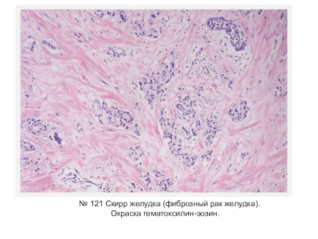 № 121 Скирр желудка (фиброзный рак желудка). Окраска гематоксилин-эозин.
