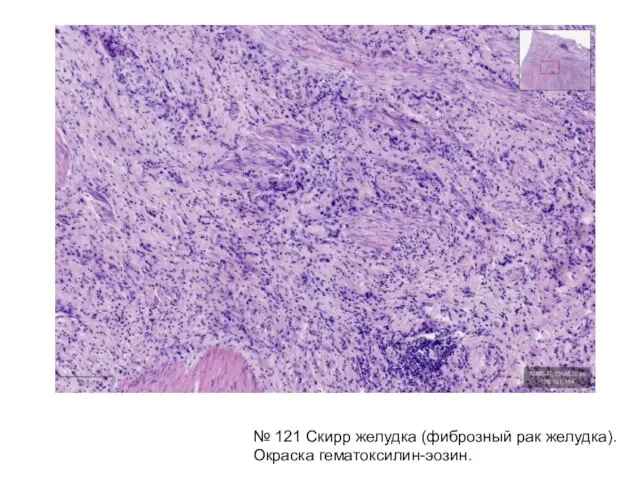 № 121 Скирр желудка (фиброзный рак желудка). Окраска гематоксилин-эозин.