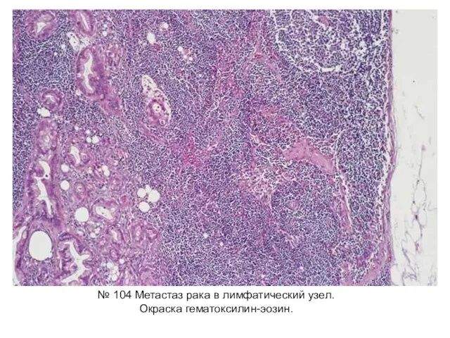 № 104 Метастаз рака в лимфатический узел. Окраска гематоксилин-эозин.