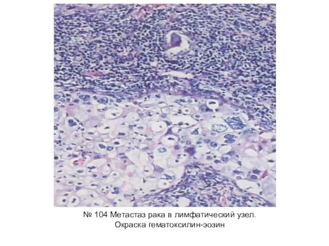 № 104 Метастаз рака в лимфатический узел. Окраска гематоксилин-эозин
