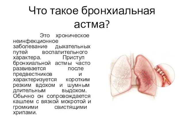 Что такое бронхиальная астма? Это хроническое неинфекционное заболевание дыхательных путей воспалительного