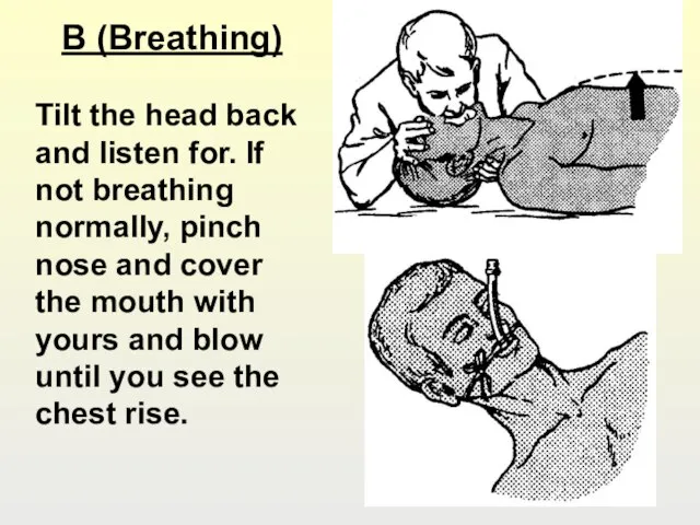 B (Breathing) Tilt the head back and listen for. If not