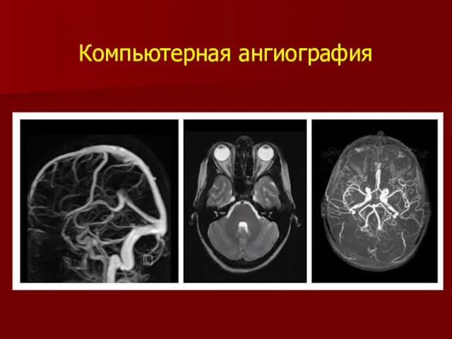 Компьютерная ангиография