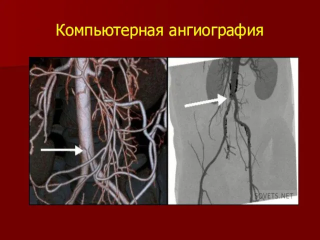 Компьютерная ангиография