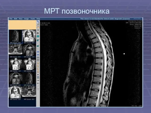 МРТ позвоночника