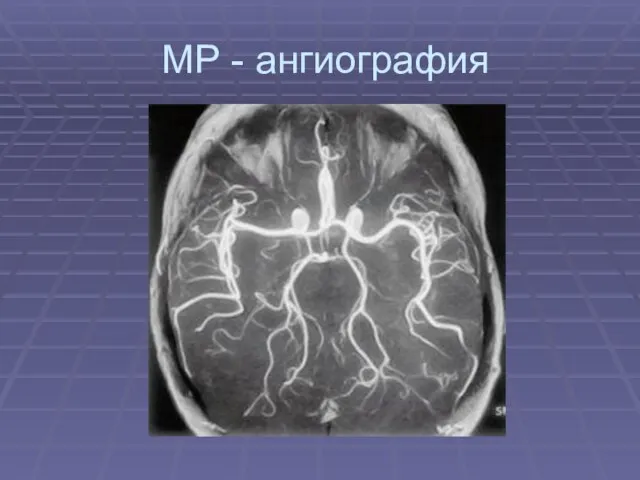 МР - ангиография