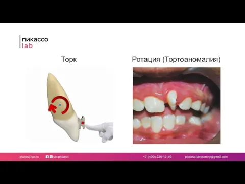 Торк Ротация (Тортоаномалия)