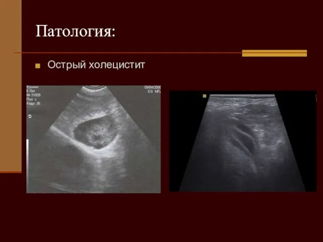 Патология: Острый холецистит