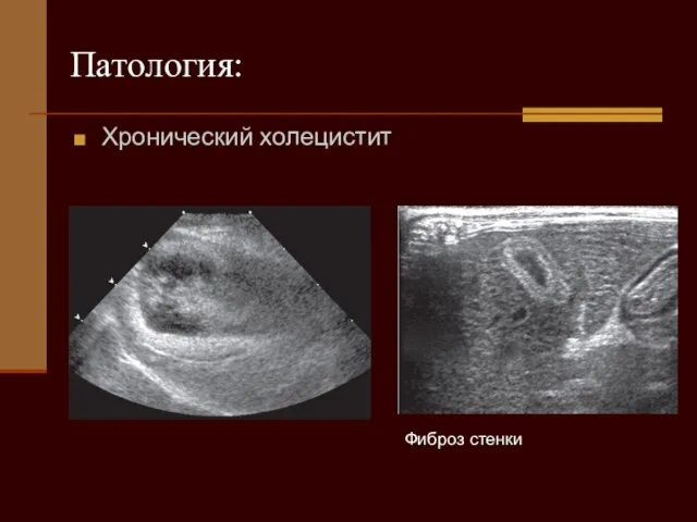 Фиброз стенки Патология: Хронический холецистит