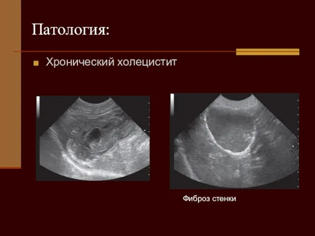 Фиброз стенки Патология: Хронический холецистит