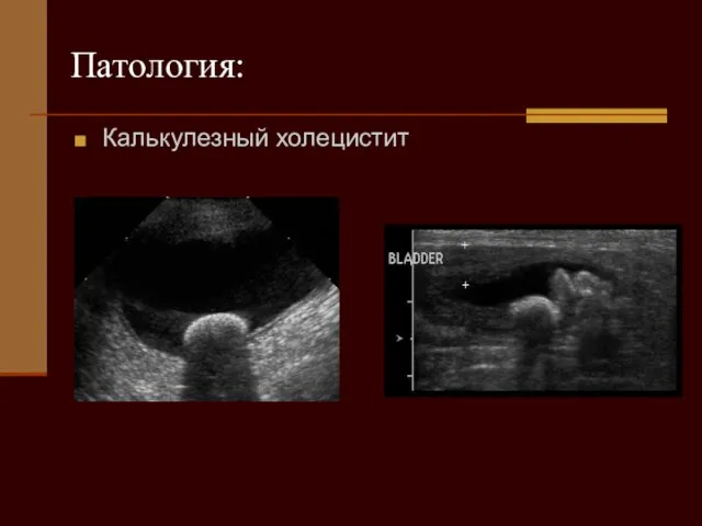 Патология: Калькулезный холецистит