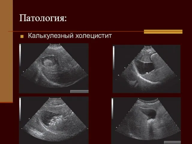 Патология: Калькулезный холецистит