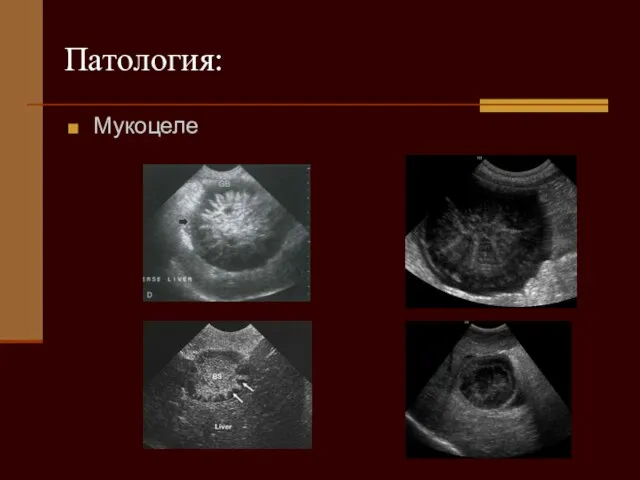 Патология: Мукоцеле