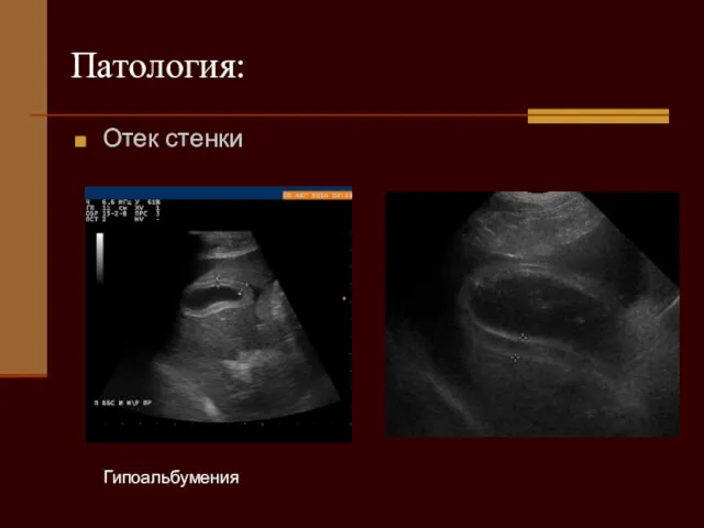 Гипоальбумения Патология: Отек стенки