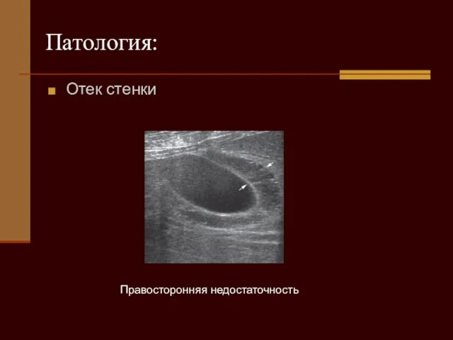 Правосторонняя недостаточность Патология: Отек стенки