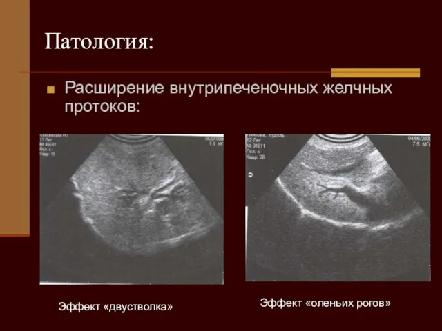 Патология: Расширение внутрипеченочных желчных протоков: Эффект «оленьих рогов» Эффект «двустволка»