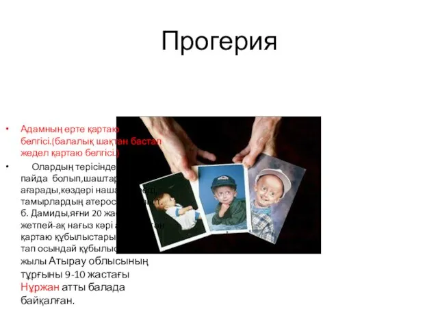 Прогерия Адамның ерте қартаю белгісі.(балалық шақтан бастап жедел қартаю белгісі.) Олардың