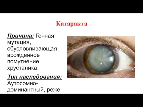 Катаракта Причина: Генная мутация, обусловливающая врожденное помутнение хрусталика. Тип наследования: Аутосомно-доминантный,