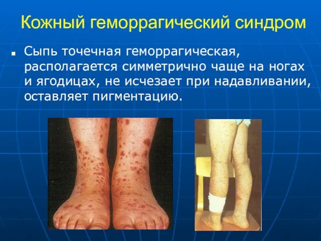 Кожный геморрагический синдром Сыпь точечная геморрагическая, располагается симметрично чаще на ногах