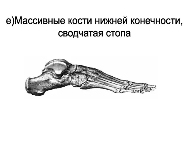 е)Массивные кости нижней конечности, сводчатая стопа