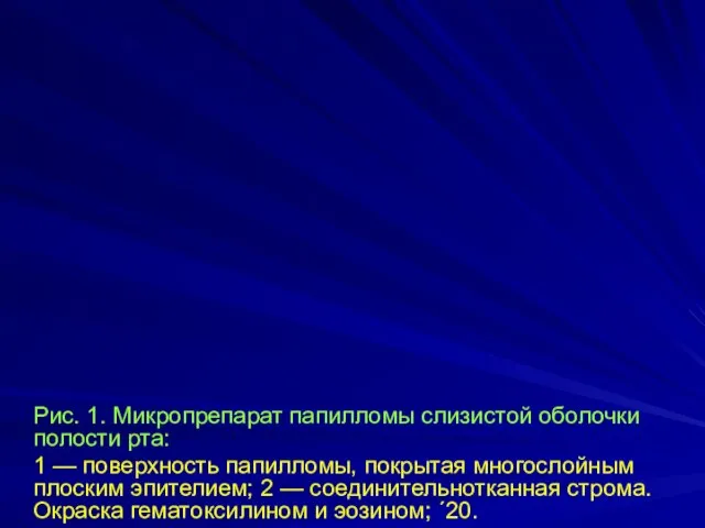 Рис. 1. Микропрепарат папилломы слизистой оболочки полости рта: 1 — поверхность