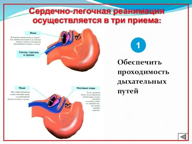 Сердечно-легочная реанимация осуществляется в три приема: Обеспечить проходимость дыхательных путей 1