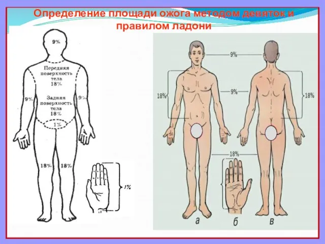 Определение площади ожога методом девяток и правилом ладони