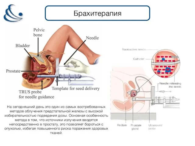 Брахитерапия На сегодняшний день это один из самых востребованных методов облучения