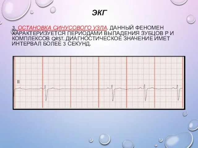 ЭКГ 3. ОСТАНОВКА СИНУСОВОГО УЗЛА. ДАННЫЙ ФЕНОМЕН ХАРАКТЕРИЗУЕТСЯ ПЕРИОДАМИ ВЫПАДЕНИЯ ЗУБЦОВ