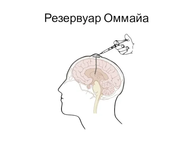 Резервуар Оммайа