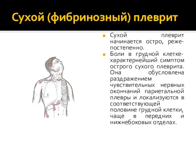 Сухой (фибринозный) плеврит Сухой плеврит начинается остро, реже- постепенно. Боли в