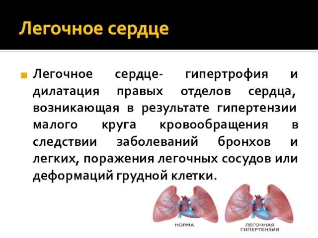Легочное сердце Легочное сердце- гипертрофия и дилатация правых отделов сердца, возникающая