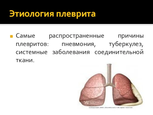 Этиология плеврита Самые распространенные причины плевритов: пневмония, туберкулез, системные заболевания соединительной ткани.